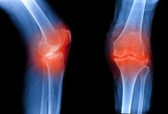 Причины, симптомы и лечение остеоартроза суставов