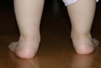 Вальгусная деформация стоп у детей — причины развития и лечение