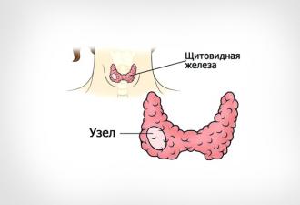 Увеличение щитовидной железы: симптомы, диагностика и лечение