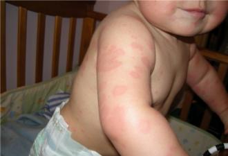Причины возникновения аллергической сыпи у детей: фото, методы лечения, полезные рекомендации